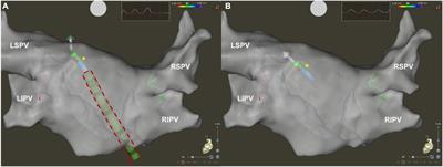 Visualizable vs. standard, non-visualizable steerable sheath for pulmonary vein isolation procedures: Randomized, single-centre trial